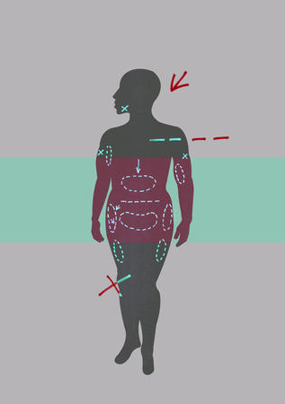 Liposuction