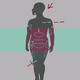 Liposuction